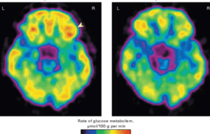 Mozek a EMF záření